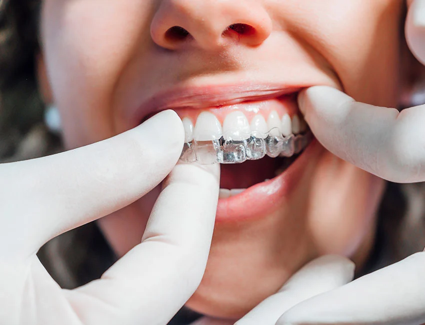 Signs you may need invisalign — West Hollywood Dental Studio