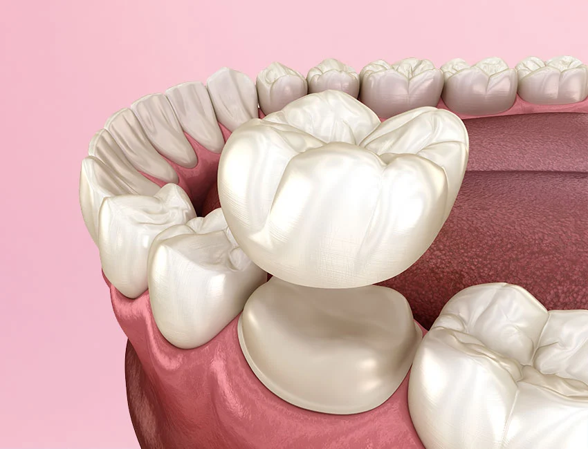 Signs you may need dental crowns — West Hollywood Dental Studio