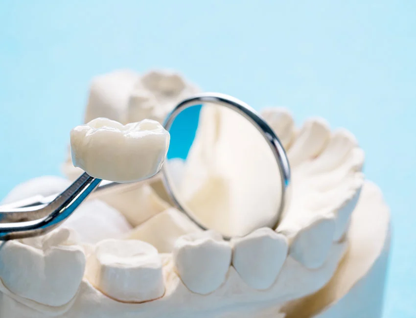 Dental Crowns at West Hollywood Dental Studio