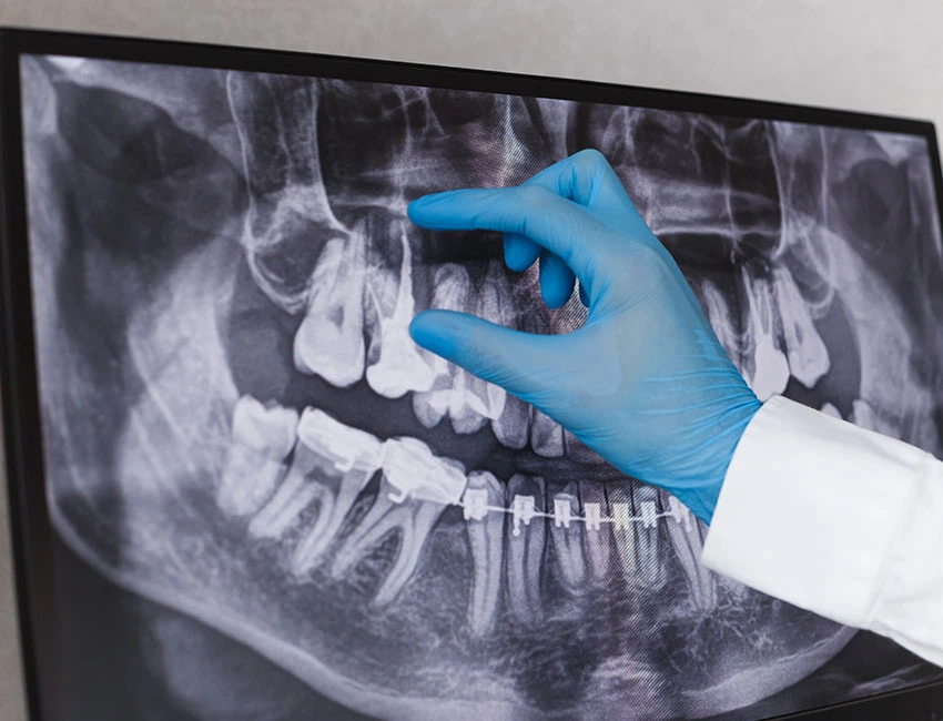 Digital X-Rays at West Hollywood Dental Studio