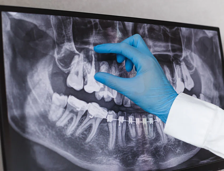 Root Canal Treatment at West Hollywood Dental Studio