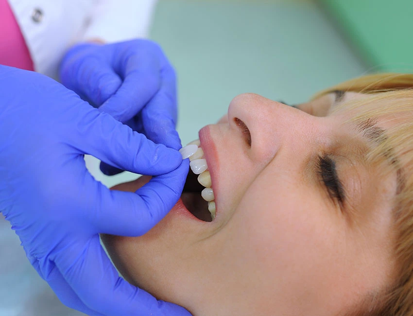 Porcelain Veneers at West Hollywood Dental Studio