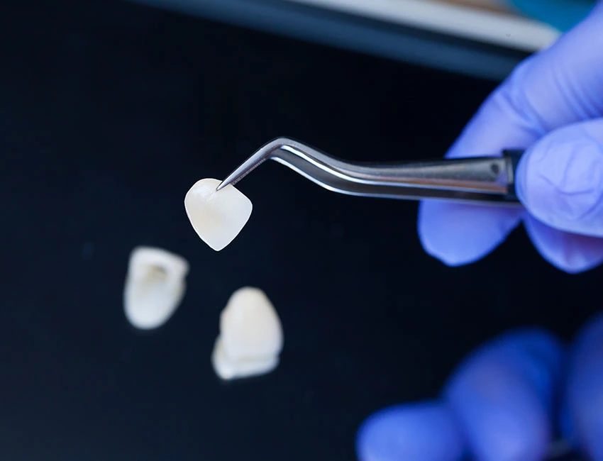 Signs you may need porcelain veneers — West Hollywood Dental Studio