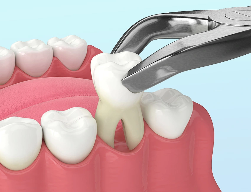 Signs you may need tooth extraction — West Hollywood Dental Studio