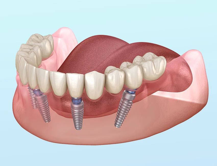 Implantes All-on-4 de Arco Completo