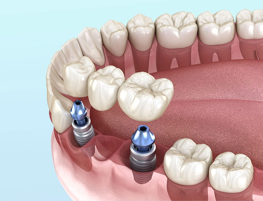 Puentes de Implantes para Múltiples Dientes