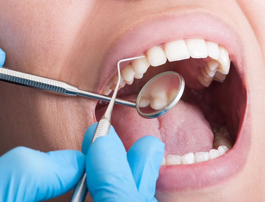 ¿Qué Esperar Durante una Limpieza Dental Profunda? — West Hollywood Dental Studio