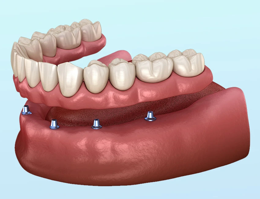 Dentaduras Soportadas por Implantes (Overdentures)