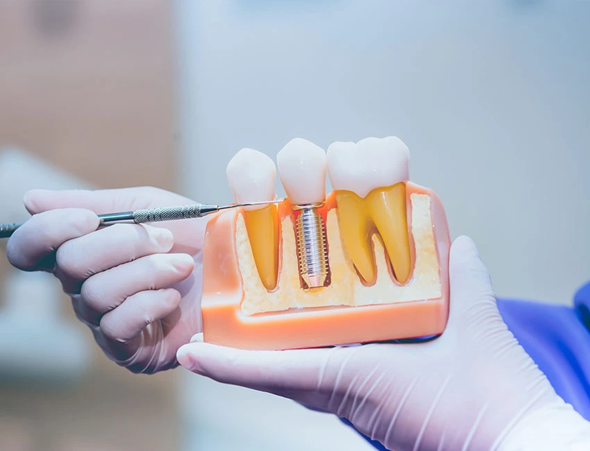 Implantes Dentales en West Hollywood Dental Studio