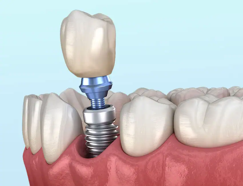 options for dental implants