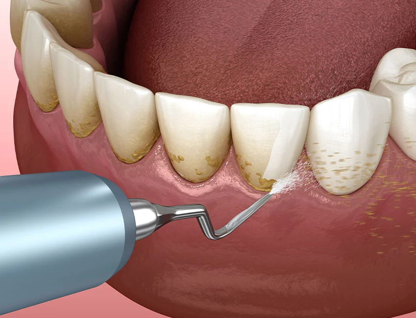 Signs you may need teeth cleaning — West Hollywood Dental Studio