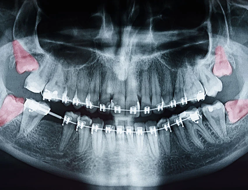 Signs you may need wisdom teeth removal — West Hollywood Dental Studio
