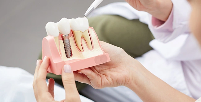 Dental Implants in West Hollywood, CA