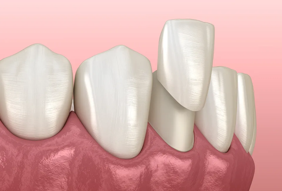 veneers