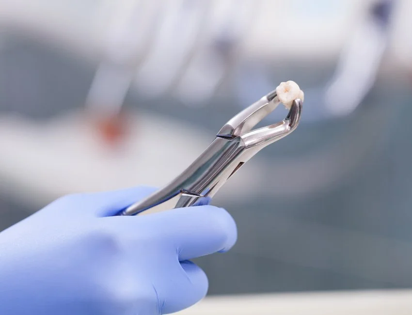 Tooth Extraction at West Hollywood Dental Studio