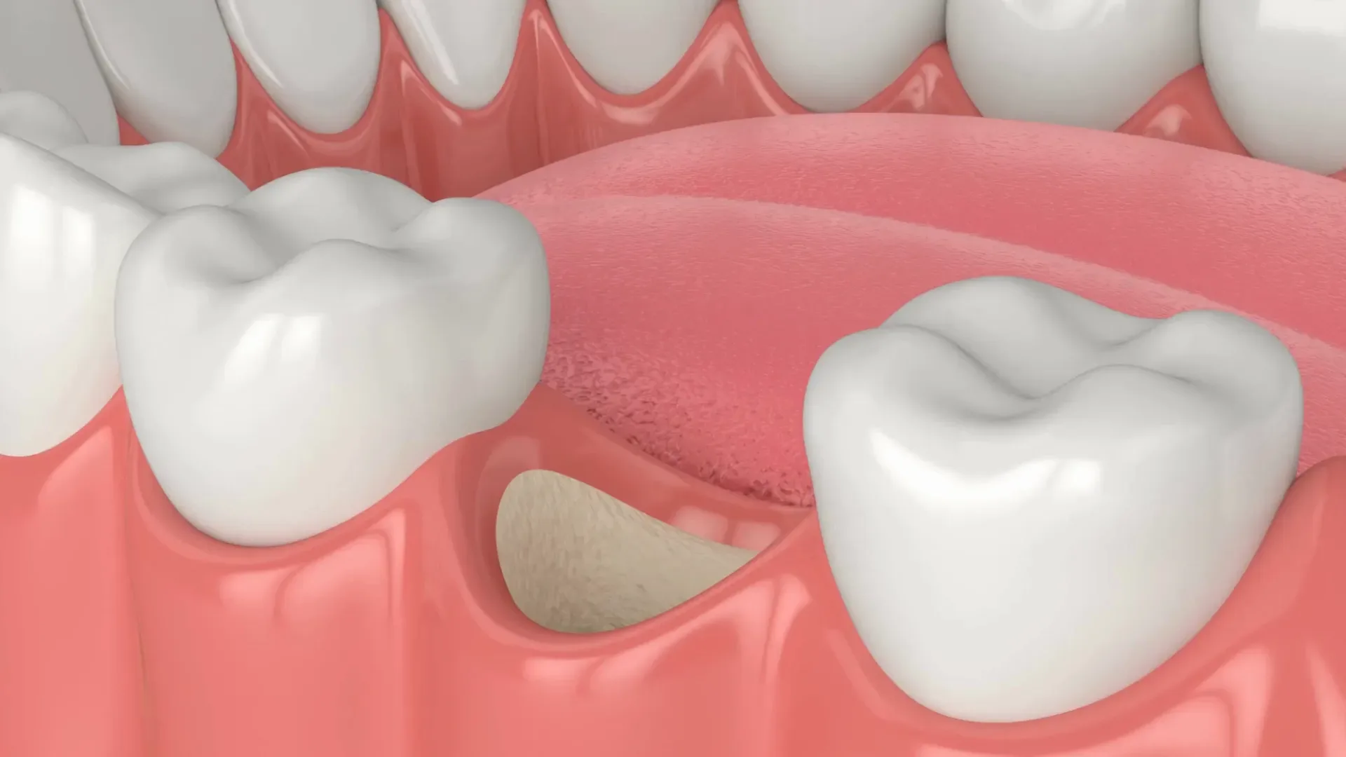 Signs you may need bone grafting — West Hollywood Dental Studio