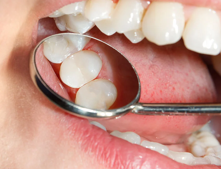 Dental Fillings at West Hollywood Dental Studio
