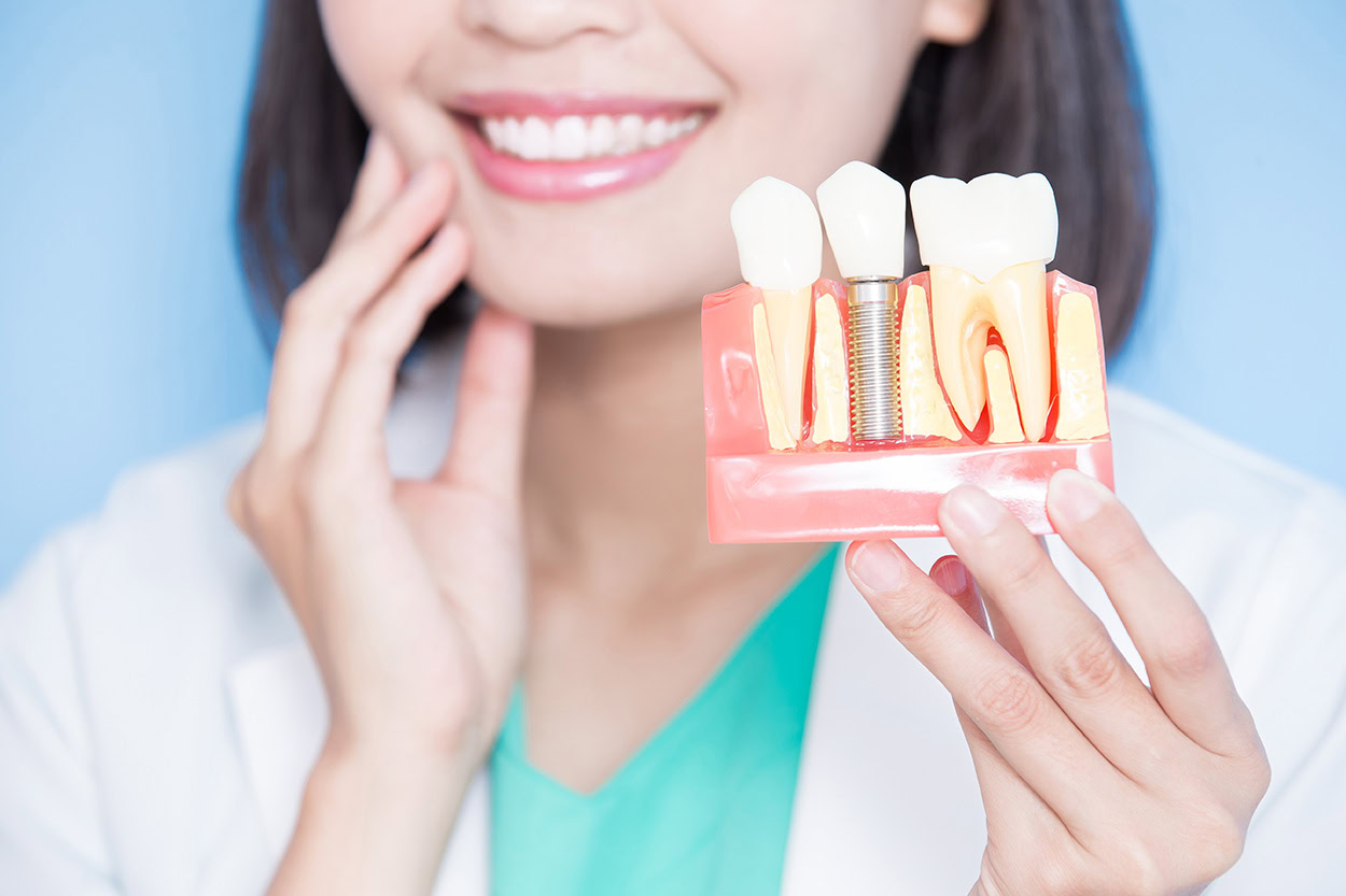 dental implants model