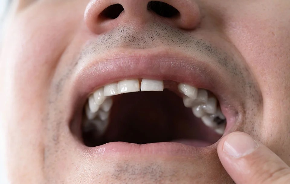 missing teeth dental implants