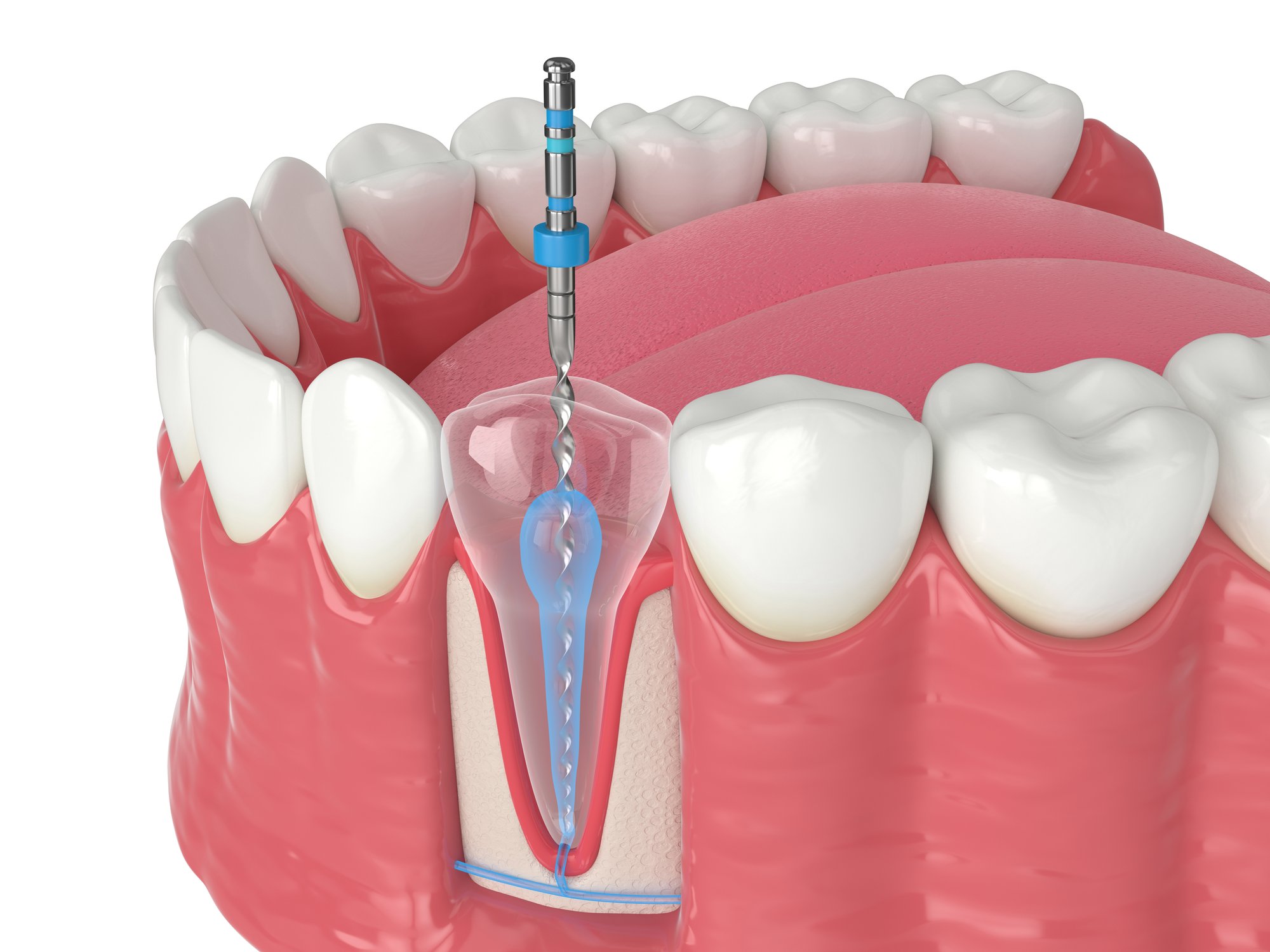 root canal explained