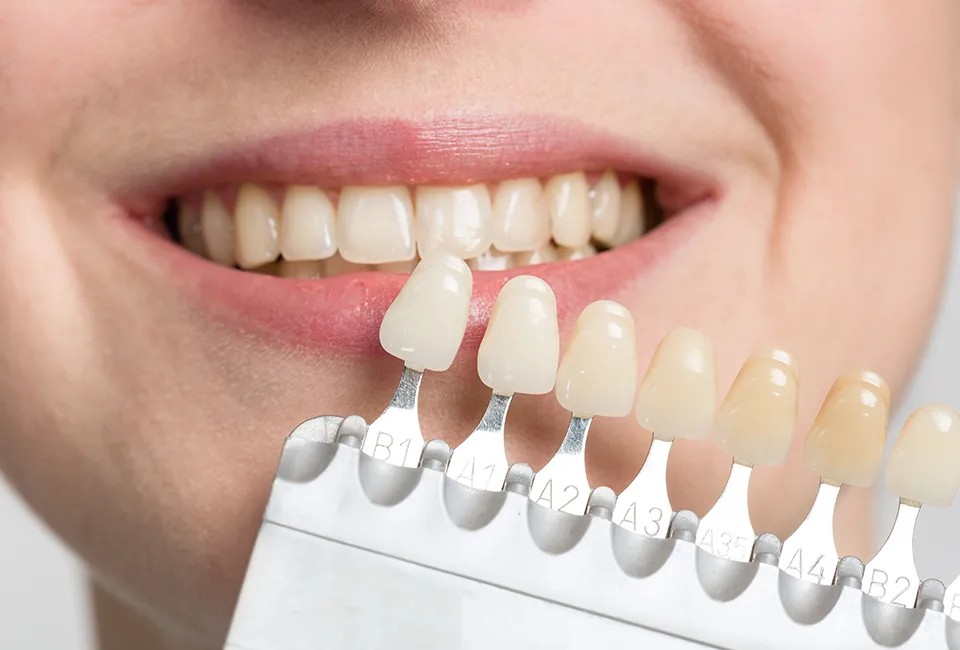 Teeth Whitening in West Hollywood