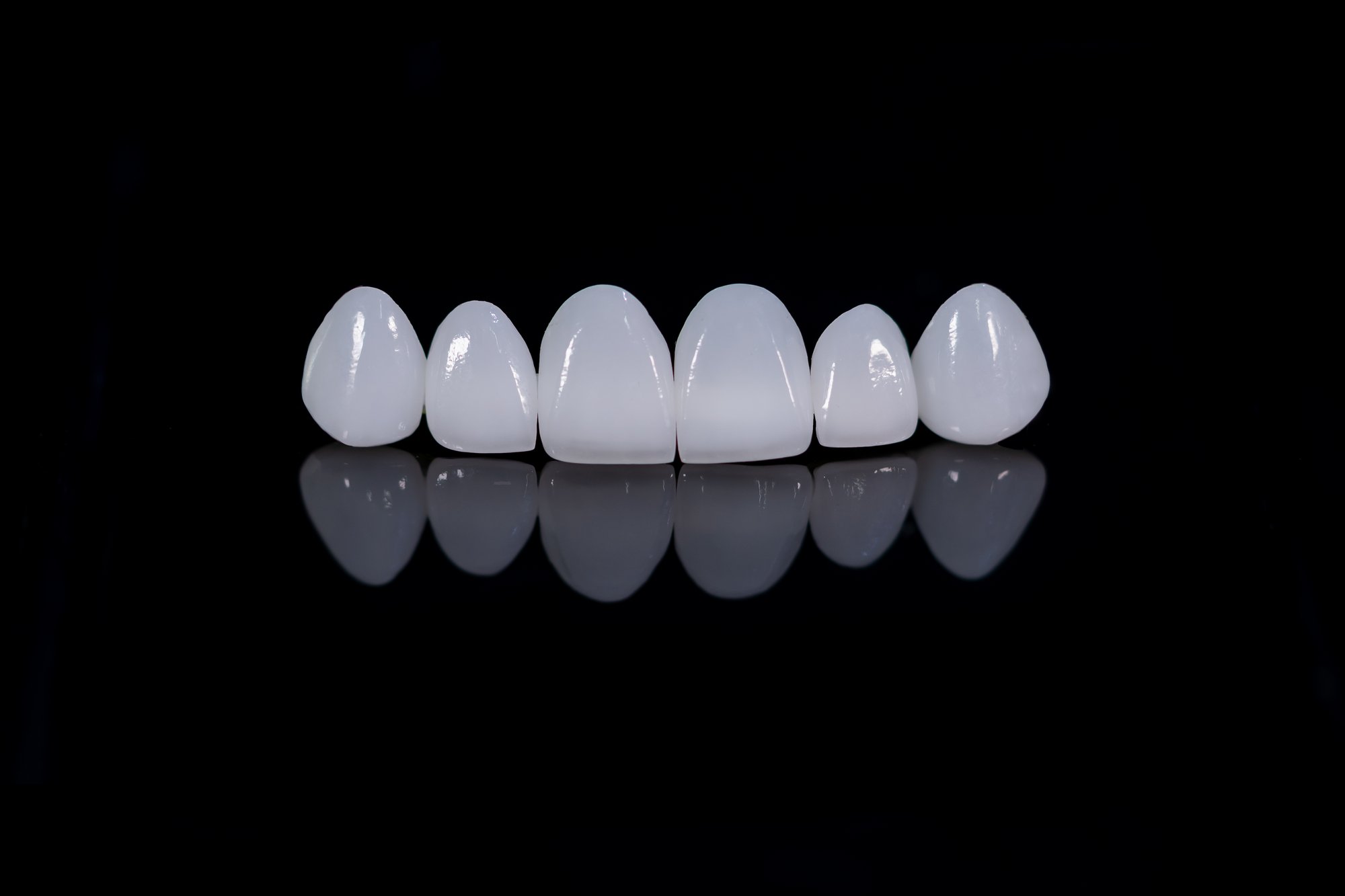 porcelain dental veneers